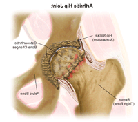 Illustration of an Arthritic Hip Joint
